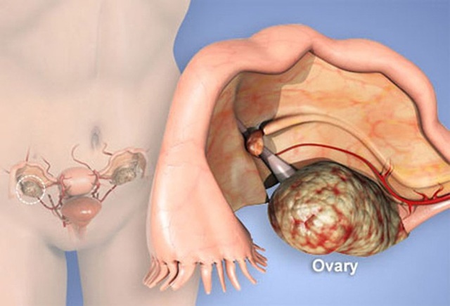 
Những dấu hiệu khi có khối u rất dễ bị nhầm với các triệu chứng của bệnh khác, dẫn đến chủ quan (Ảnh minh họa).
