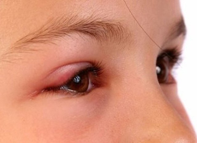 
Viêm kết mạc hay đau mắt đỏ thường do adenovirus – loại virus có thể gây viêm họng, viêm phế quản và đau họng.
