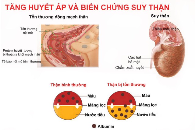 Tăng huyết áp có thể gây suy thận