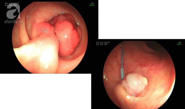 Cắt polyp đại tràng qua nội soi.