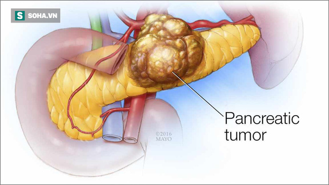 Sốt, đau bụng đi kèm các dấu hiệu này: Hãy cảnh giác cao độ với bệnh ung thư tuyến tụy - Ảnh 1.