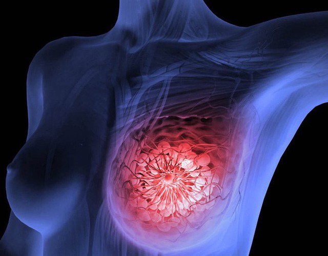 BS cảnh báo nhiều trường hợp 20 tuổi đã mắc ung thư vú: 4 bước tự khám vú phụ nữ cần biết - Ảnh 1.