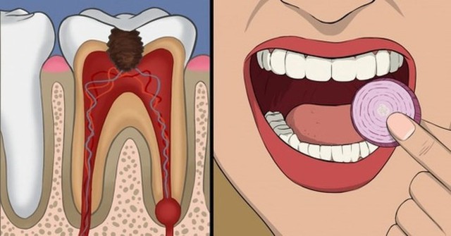 11 cách giúp bạn dịu cơn đau do mọc răng khôn - Ảnh 10.