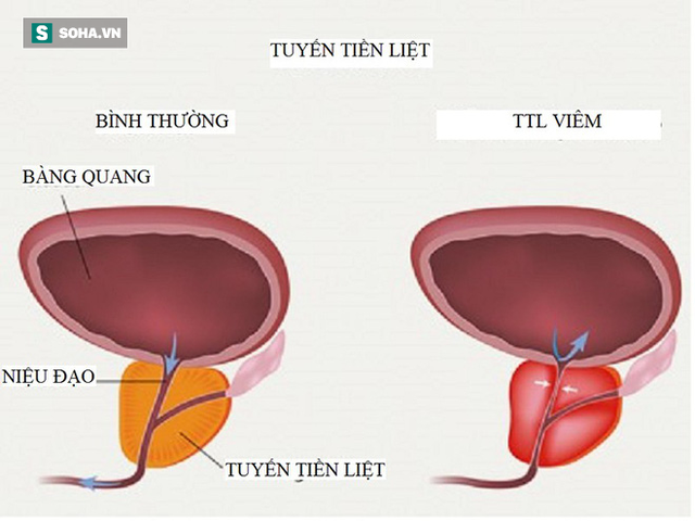  Bác sĩ cảnh báo sớm 5 triệu chứng viêm tuyến tiền liệt: Nếu ai thấy giống là phải đi khám - Ảnh 1.