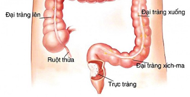  Tỷ lệ mắc ung thư ruột tăng 50% sau 10 năm: 3 yếu tố gây bệnh nhiều người đang coi nhẹ - Ảnh 1.