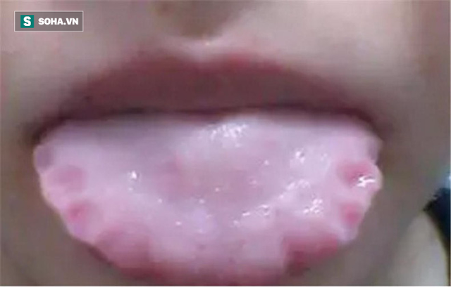 Khi thấy dấu hiệu này trên lưỡi, hãy cẩn thận với bệnh dạ dày và khẩn trương đi khám - Ảnh 1.