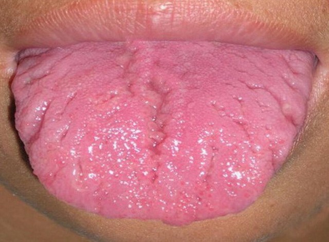 Khi thấy dấu hiệu này trên lưỡi, hãy cẩn thận với bệnh dạ dày và khẩn trương đi khám - Ảnh 3.