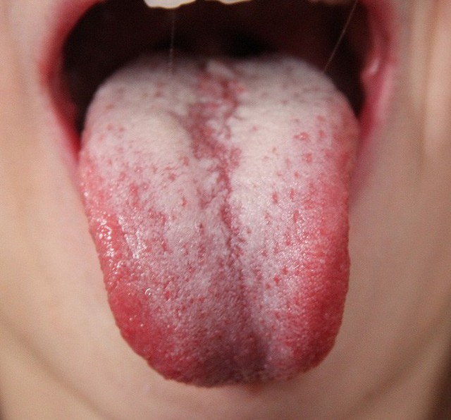 Khi thấy dấu hiệu này trên lưỡi, hãy cẩn thận với bệnh dạ dày và khẩn trương đi khám - Ảnh 4.