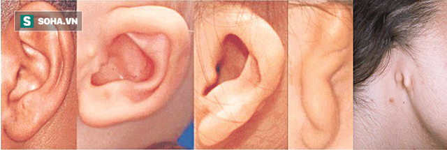  Nhìn tai bắt bệnh: Những dấu hiệu nguy hiểm bạn không ngờ - Ảnh 2.