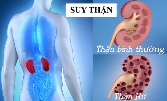  Bệnh thận - căn bệnh gây đau đớn ám ảnh: Làm ngay 4 điều này để phòng bệnh - Ảnh 1.