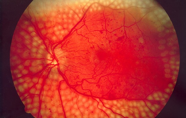 4 căn bệnh ở mắt nếu không chữa trị sớm có thể dẫn tới nguy cơ mù lòa - Ảnh 2.