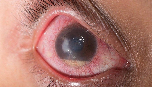 4 căn bệnh ở mắt nếu không chữa trị sớm có thể dẫn tới nguy cơ mù lòa - Ảnh 3.