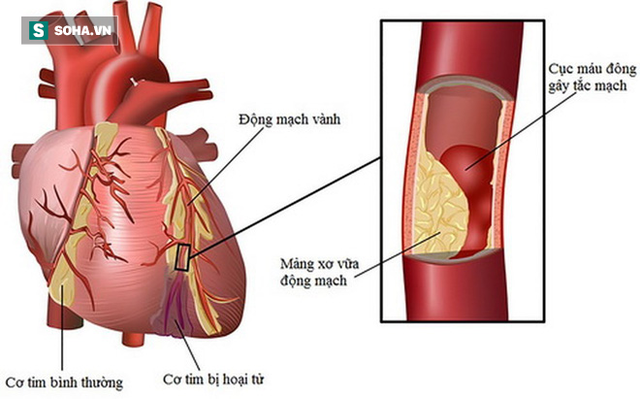 Chuyên gia cảnh báo: Mắc tiểu đường phải đề phòng cái chết bất ngờ do biến chứng tim mạch - Ảnh 1.