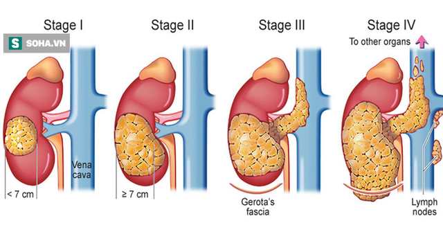  36 tuổi bị tử vong vì ung thư thận: Bác sĩ cảnh báo những thói quen bạn nên xem lại - Ảnh 3.