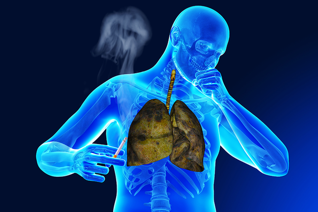  Khi bị ho, sốt và 3 dấu hiệu đi kèm cùng lúc, cẩn thận ung thư phổi đã vào giai đoạn nặng - Ảnh 3.