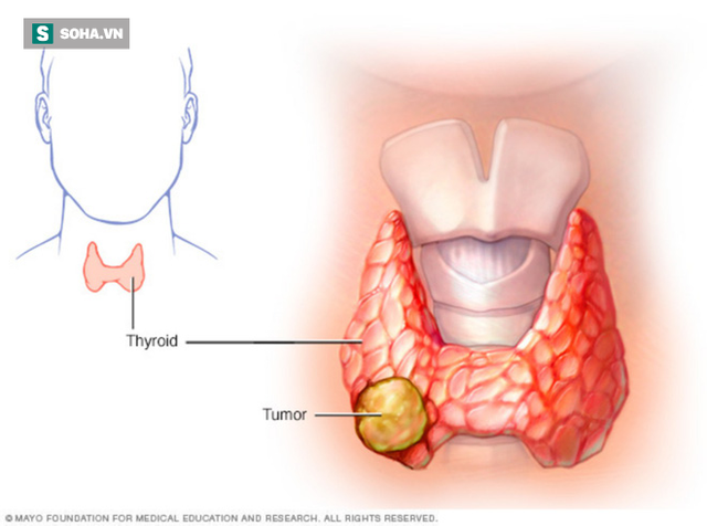 6 dấu hiệu cảnh báo ung thư tuyến giáp sớm nhất: Cơ hội sống gần 100% vì điều trị kịp thời - Ảnh 1.
