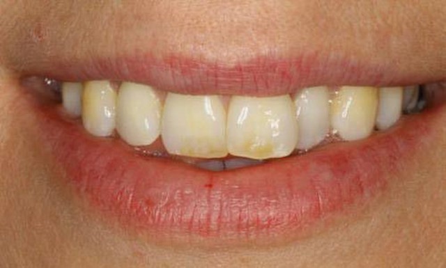 Biểu hiện lạ của răng miệng có thể cảnh báo những căn bệnh tiềm ẩn bên trong - Ảnh 5.
