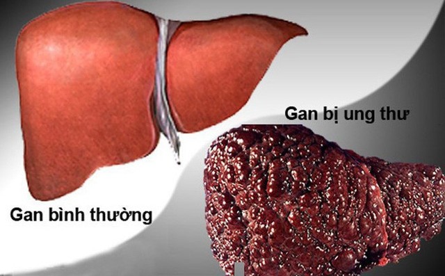  Chuyên gia hàng đầu bày cách phòng tránh ung thư gan - căn bệnh nguy hiểm khó phát hiện - Ảnh 1.