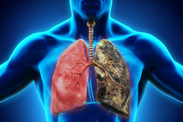 Ung thư phổi: Căn bệnh có thể mắc phải bất cứ lúc nào và nguyên nhân lại đến từ những thứ thân thuộc xung quanh bạn - Ảnh 4.
