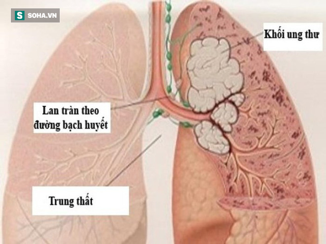  Những dấu hiệu sớm của bệnh ung thư phổi ở nam giới - Ảnh 1.