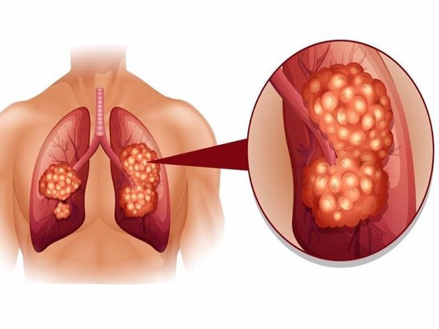 Lý do nguy hiểm khiến đa số bệnh nhân ung thư phổi đều phát hiện bệnh ở giai đoạn muộn - Ảnh 1.