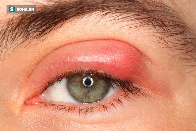 
Chắp mắt là một triệu chứng của bệnh đái tháo đường
