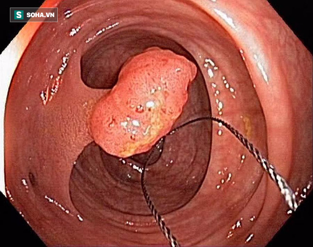  95% ca ung thư đại tràng liên quan đến nguyên nhân này, làm sao để phòng bệnh đúng cách? - Ảnh 3.