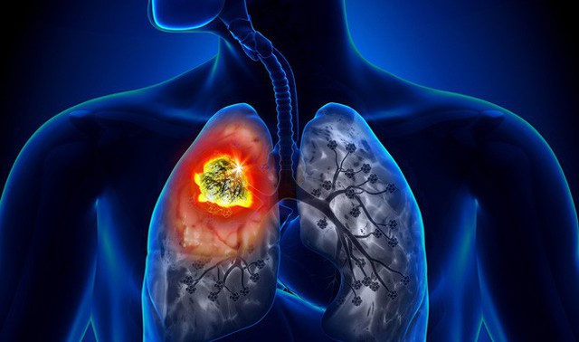Người đàn ông được phát hiện ung thư phổi sau 10 ngày ho khan, cảnh báo dấu hiệu sớm của bệnh phải cẩn trọng - Ảnh 1.
