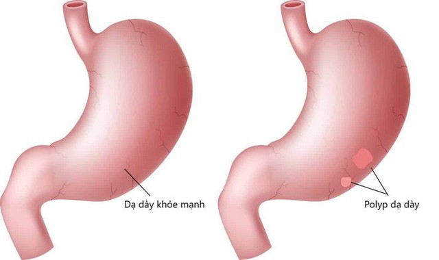 Những nhóm người dễ bị ung thư dạ dày: 3 việc cần làm ngay để ngăn ngừa mắc bệnh - Ảnh 1.