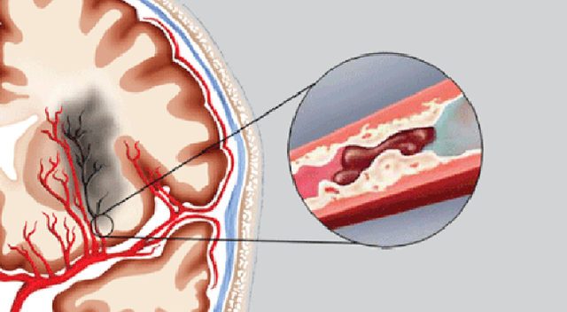 Người đàn ông 45 tuổi máu đặc như cháo rồi tử vong trong đêm khuya do thường xuyên ăn món ăn rất quen thuộc với gia đình Việt - Ảnh 1.