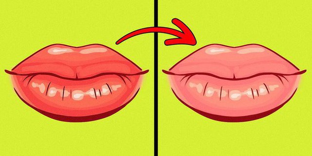 8 dấu hiệu của đôi môi cần đặc biệt chú ý vì sức khoẻ của bạn đang gặp vấn đề - Ảnh 6.