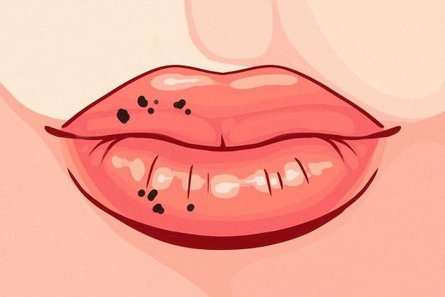 8 dấu hiệu của đôi môi cần đặc biệt chú ý vì sức khoẻ của bạn đang gặp vấn đề - Ảnh 8.