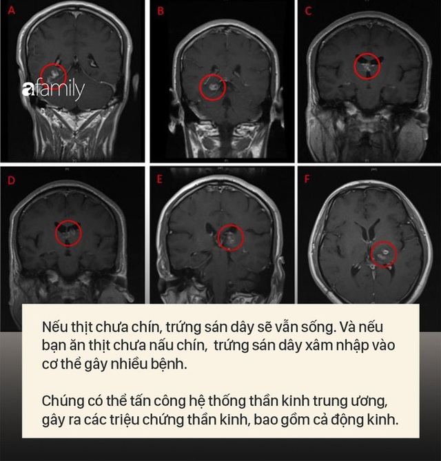 Bác sĩ phát hiện 700 con sán dây làm tổ, gây tổn thương trong não, ngực và phổi, người đàn ông thú nhận do đã ăn món thịt này trước đó - Ảnh 4.