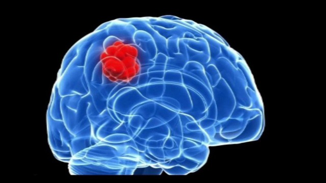 Chuyên gia bệnh viện K Trung ương chỉ ra 8 bất thường có thể là dấu hiệu của u não - Ảnh 2.