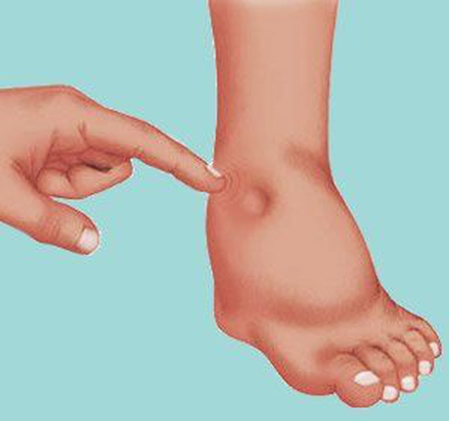Hãy cẩn thận với 6 dấu hiệu ở bàn chân nếu không muốn nhập viện cấp cứu - Ảnh 2.