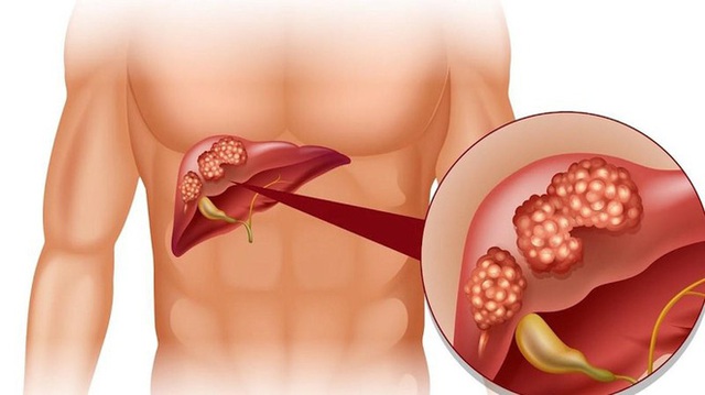 Phó chủ tịch hội Gan mật chỉ mặt 2 thói quen tàn sát lá gan của người Việt - Ảnh 2.