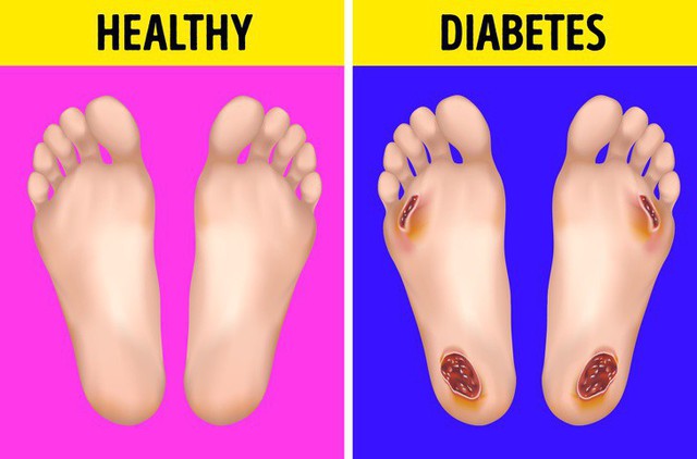 Cẩn thận với những biểu hiện khác thường ở bàn chân đang ngầm cảnh báo sớm bệnh tiểu đường - Ảnh 2.