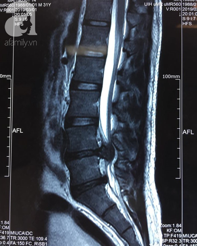 Thấy đau lưng, đừng nên coi thường: Căn bệnh hiểm này nếu can thiệp muộn sau 24 giờ có thể bị tàn phế suốt đời - Ảnh 1.