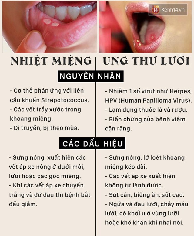 Tưởng là bị nhiệt lưỡi, ngờ đâu lại là dấu hiệu cảnh báo bệnh ung thư mà nhiều người không hay biết - Ảnh 3.