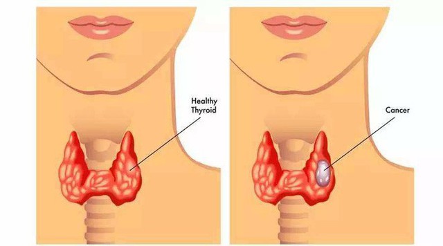  5 loại bệnh vặt không lo chữa, để quá lâu sẽ có nguy cơ tiến triển thành ung thư - Ảnh 4.