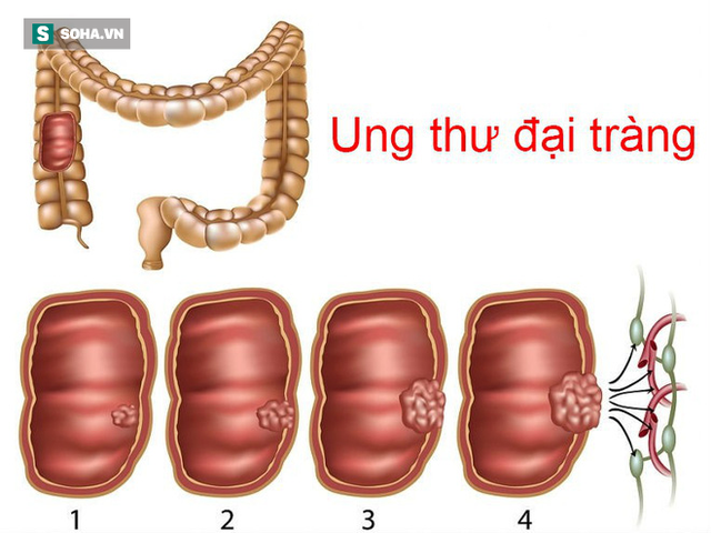 Phòng bệnh ung thư đại trực tràng: Quan trọng nhất là chế độ ăn uống và lối sống - Ảnh 1.