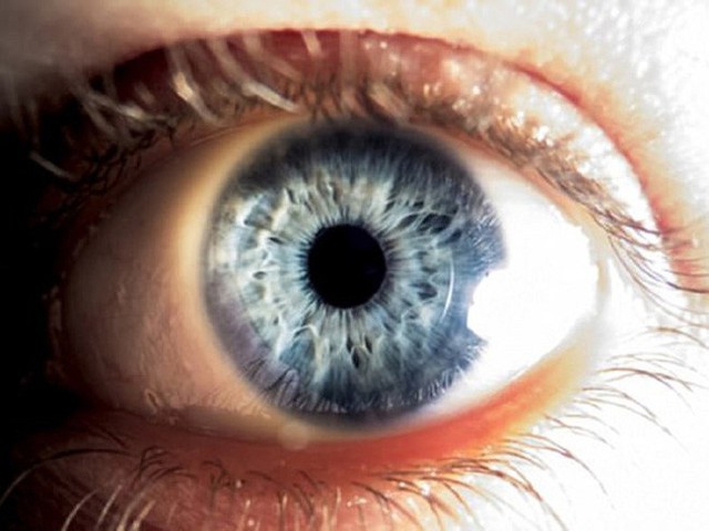 Từ trường hợp người đàn ông bị đột quỵ mắt, bác sĩ chỉ ra dấu hiệu đột quỵ mắt cần chú ý - Ảnh 1.