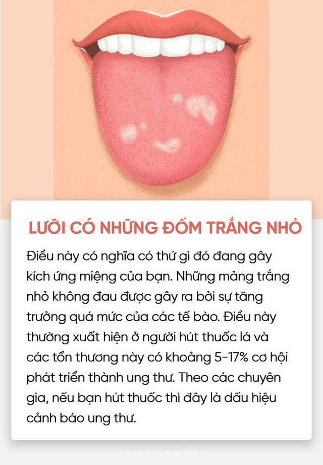 Nhìn vào lưỡi cũng có thể giúp bạn kiểm tra nhanh tình trạng sức khoẻ - Ảnh 4.