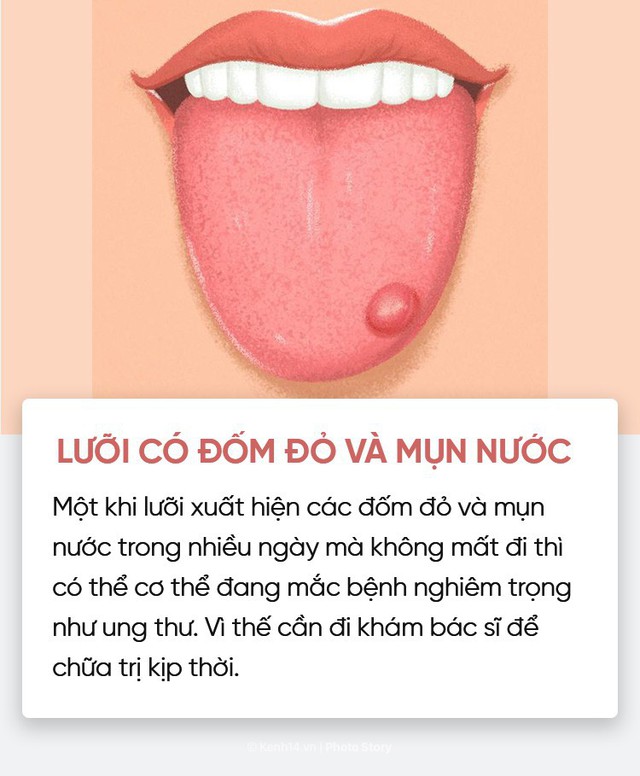 Nhìn vào lưỡi cũng có thể giúp bạn kiểm tra nhanh tình trạng sức khoẻ - Ảnh 8.