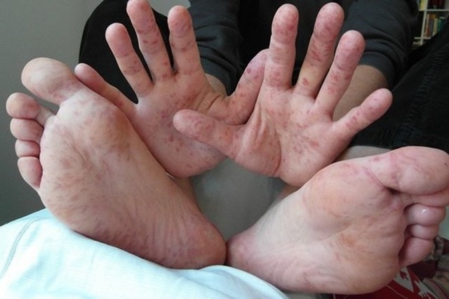 Cha mẹ cảnh giác với 3 dấu hiệu cảnh báo trẻ bị tay chân miệng thể nặng, ảnh hưởng đến thần kinh - Ảnh 1.