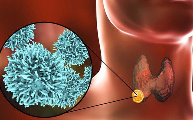  13 tuổi mắc ung thư tuyến giáp: BS cảnh báo bệnh liên quan tới thói quen ăn thiếu chất - Ảnh 1.
