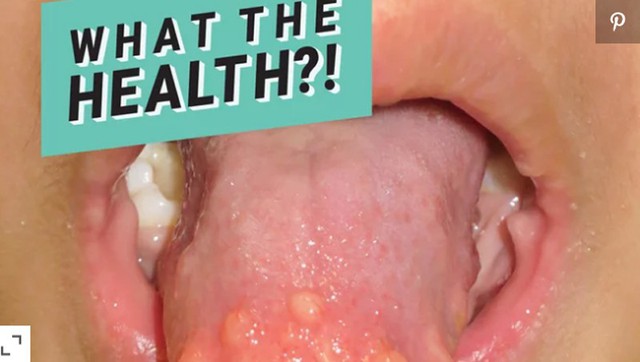 Nếu lưỡi của con bạn có dấu hiệu tương tự như em bé này, cẩn thận với bệnh ung thư tuyến giáp! - Ảnh 1.