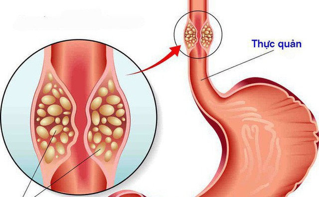 Bị ung thư lại tưởng viêm họng: 3 dấu hiệu điển hình cần nhớ, ai có cần đi khám sớm - Ảnh 2.