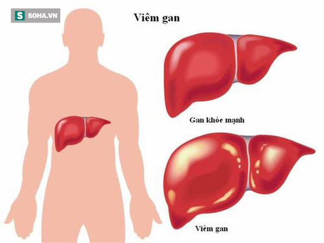  BS nói về lộ trình viêm gan - xơ gan - ung thư gan: Mỗi người cần làm 4 việc để né bệnh - Ảnh 1.