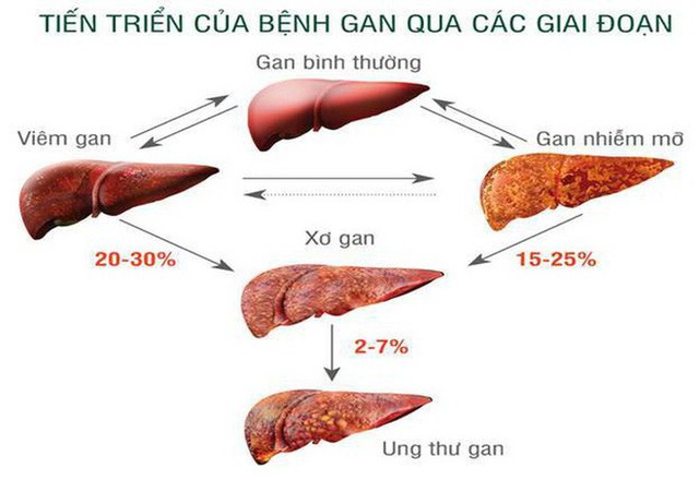  BS nói về lộ trình viêm gan - xơ gan - ung thư gan: Mỗi người cần làm 4 việc để né bệnh - Ảnh 2.